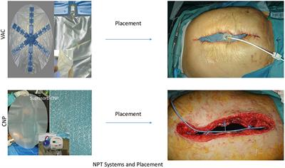 Effect of Negative Pressure Therapy on Open Abdomen Treatments. Prospective Randomized Study With Two Commercial Negative Pressure Systems